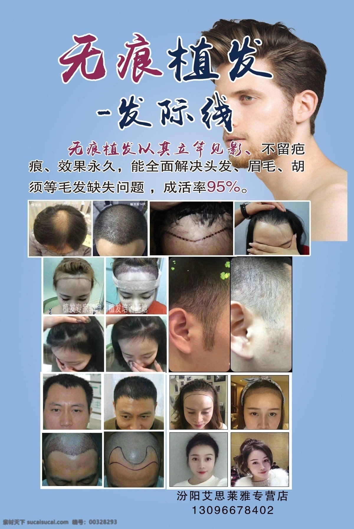 无痕植发 植发 发际线 帅哥 美容院图 植发图