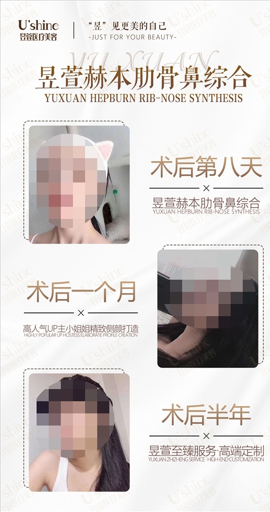 医 美 整形 医院 案例 对比 海报 医美 整形医院 案例对比 肋骨鼻 鼻子 术后