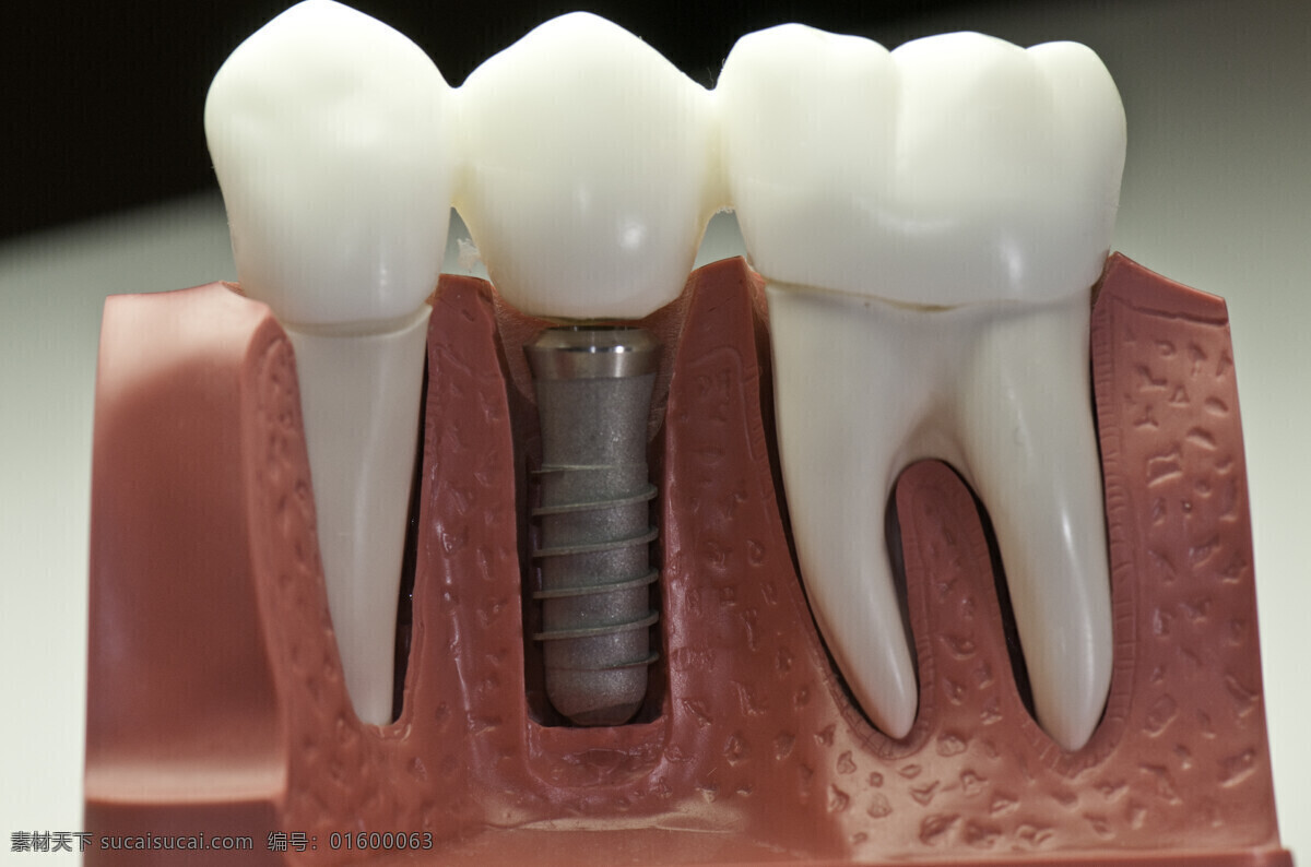 牙齿 种植 牙齿摄影 牙齿种植 假牙 牙科 人体器官 医疗 医院 人体器官图 人物图片