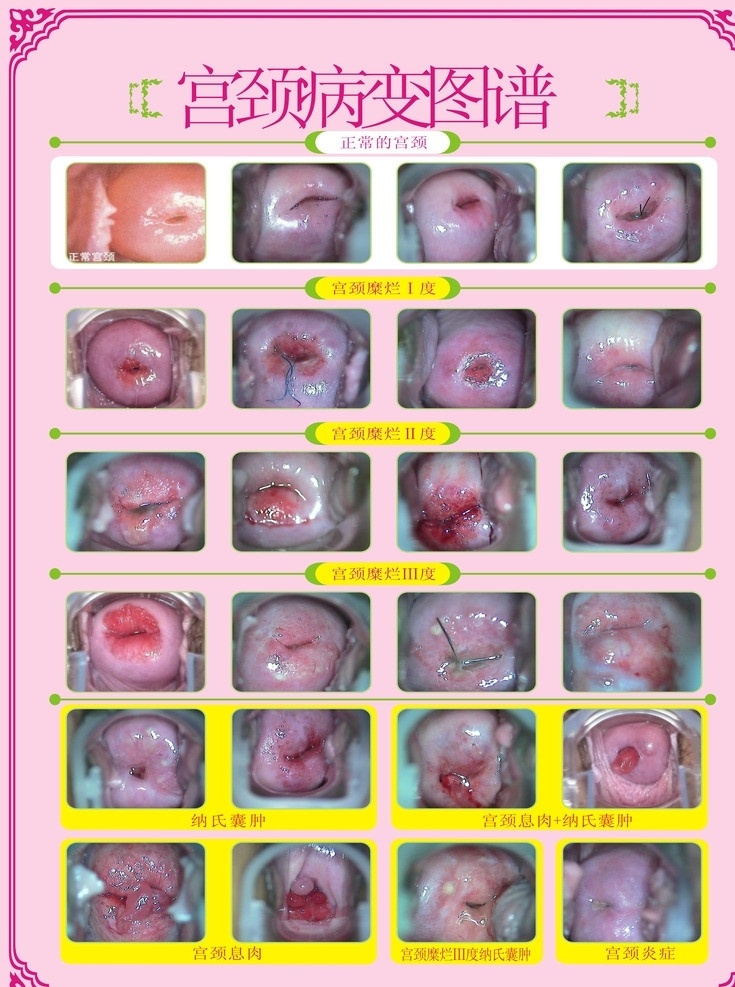宫颈病变图谱 正常的宫颈 糜烂1度 2度 3度 纳氏囊肿 宫颈息肉 宫颈炎症 矢量