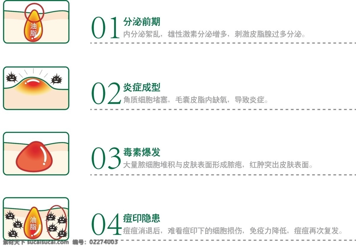 痘形成 痘痘 形成 过程 青春痘 医疗保健 生活百科 矢量
