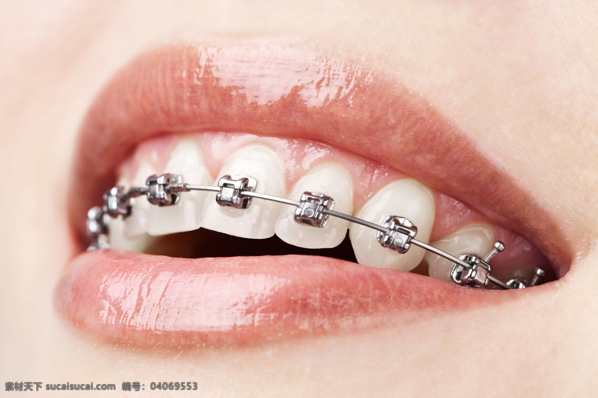 戴 牙 箍 牙齿 戴着 牙箍 牙套 牙齿整形 人体器官图 人物图片