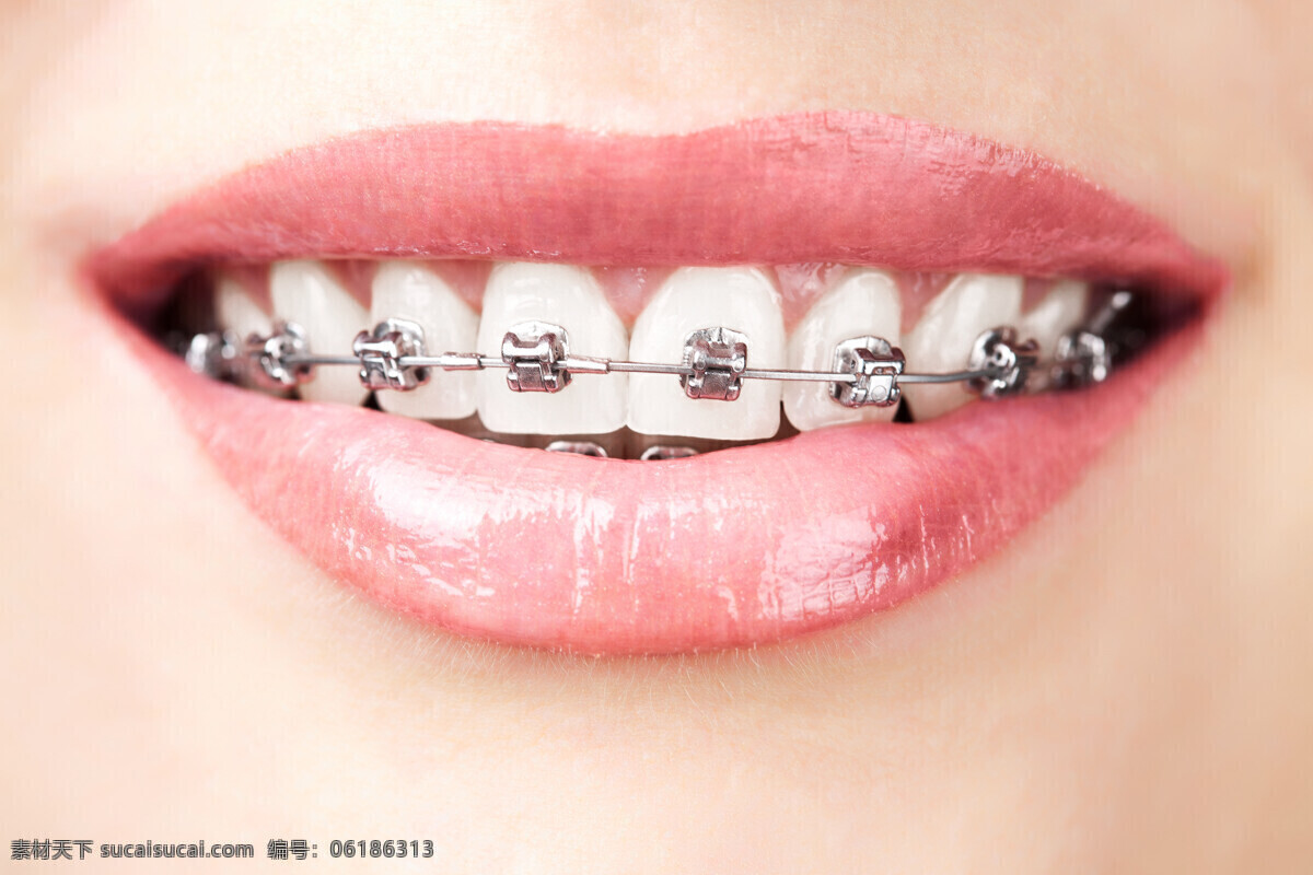 牙齿矫正 牙齿 牙箍 牙套 牙线 洁白牙齿 口腔护理 牙科 生活百科