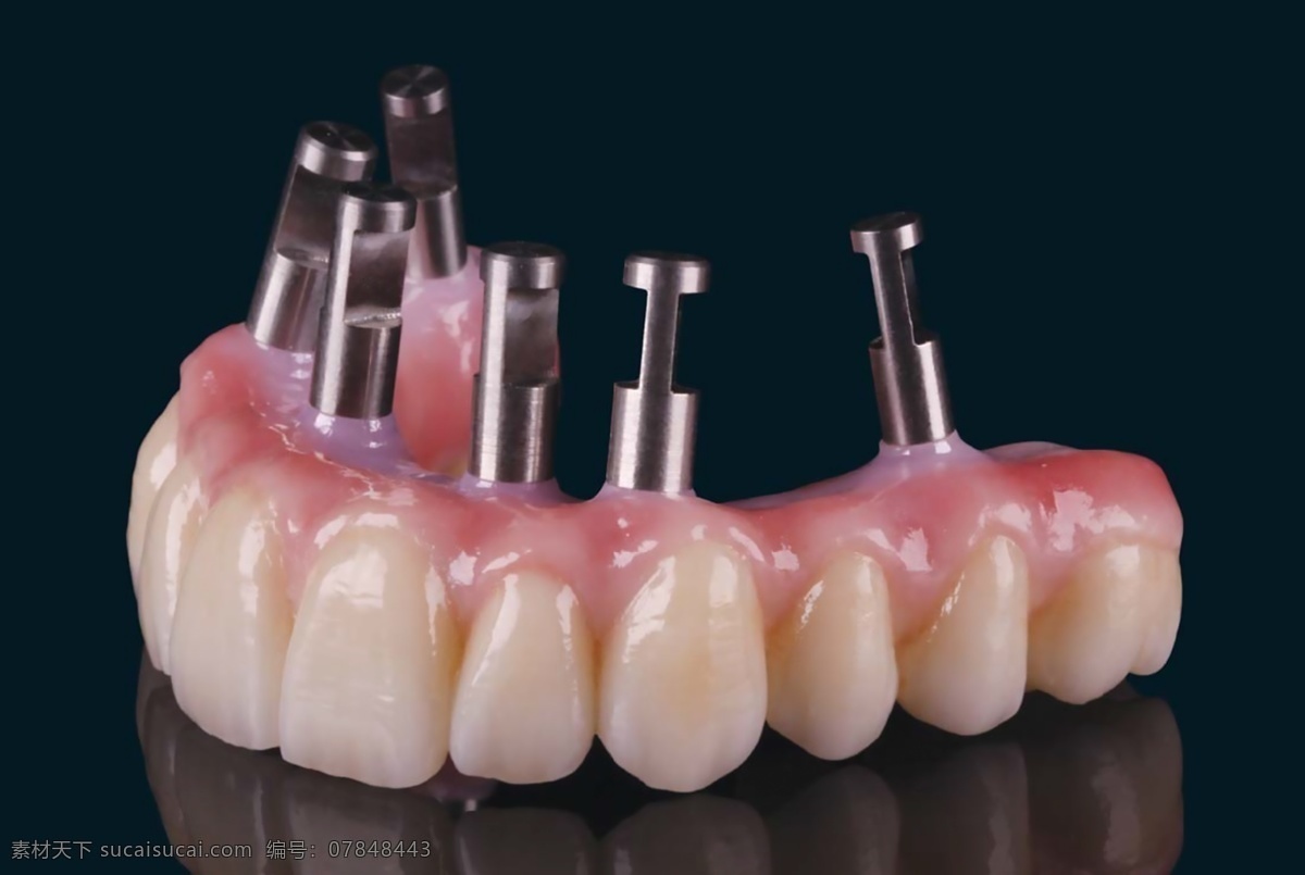 种植 牙 全 口 替代 体 细节 种植牙 牙科 假牙 烤瓷牙 固定义齿 固定假牙 义齿