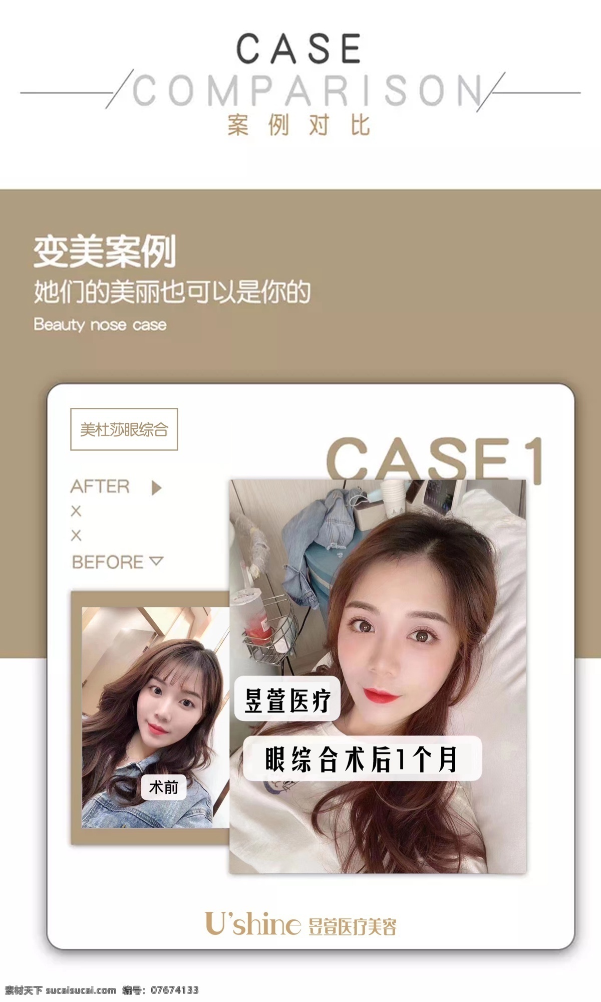 医 美 整形 医院 案例 对比 海报 医美 整形医院 案例对比 双眼皮 术后