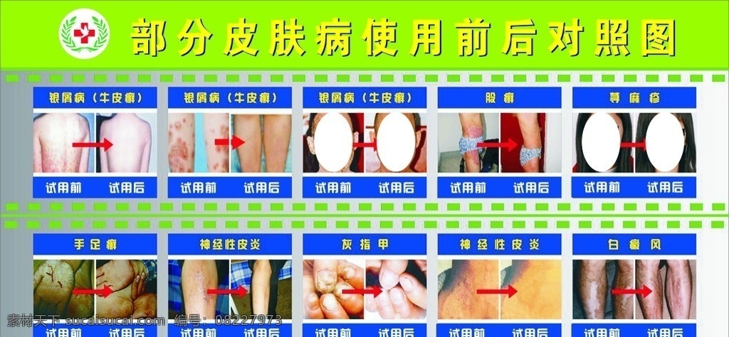 部分 皮肤病 使用 前后 对照 图 部分皮肤病 前后对照图 银屑病 股癣 底图