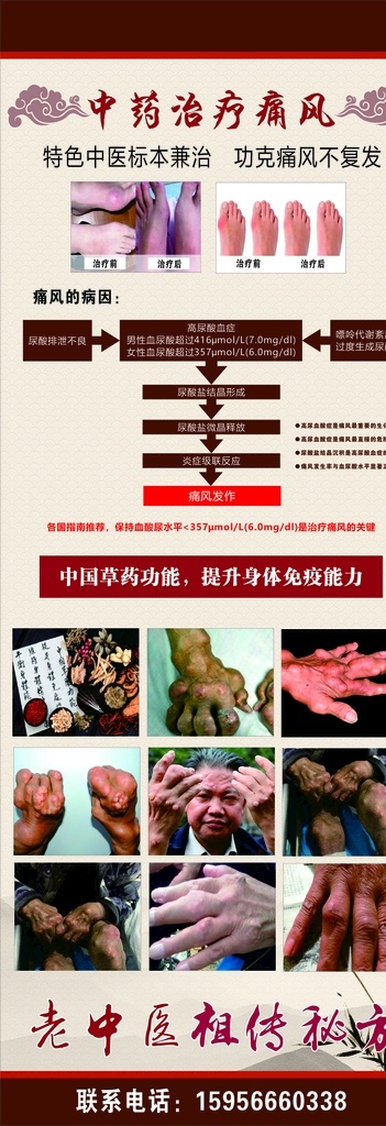 痛风展架 痛风 展架 中药 治疗 痛风的原因