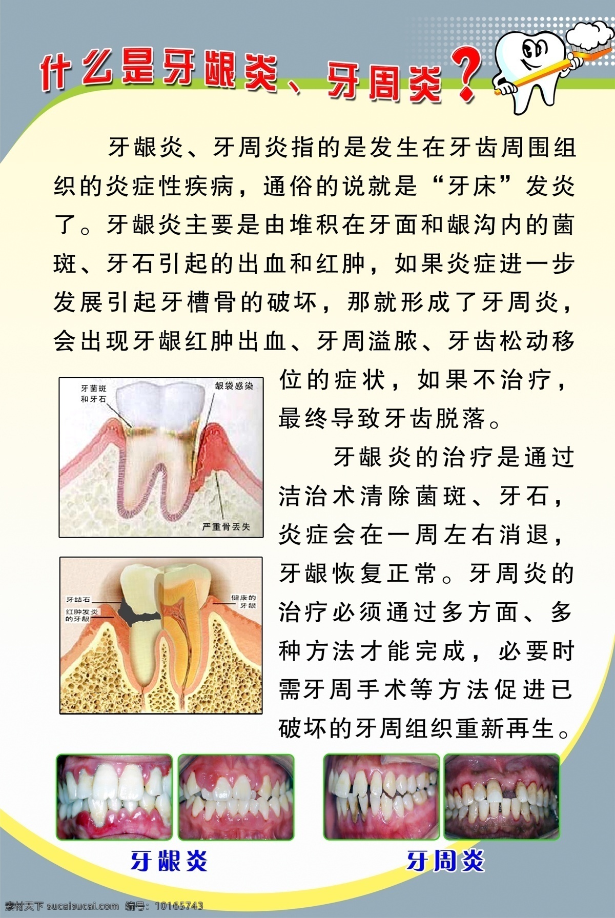 什么是牙龈炎 牙周炎 医院图板 牙龈炎 牙周炎的治疗 牙周炎的症状 广告设计模板 源文件