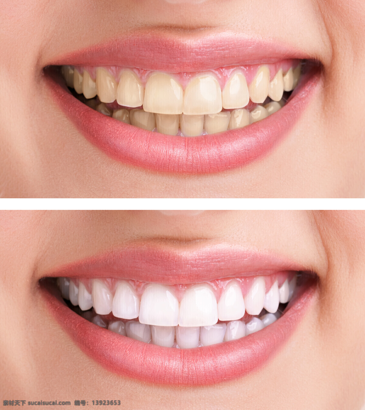 洁 牙 前后 对比 洁牙前后对比 牙齿美白 微笑 牙齿 牙科 口腔医疗 牙齿医疗 医疗科技 生活人物 人体器官图 人物图片