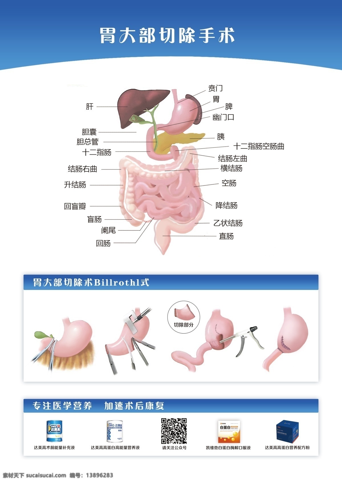 胃 大部 切除 手术 示意图 消化系统 胃肠 毕二式 胃大部切除 加速康复外科 分层
